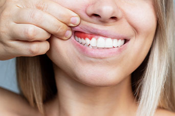 periodontitis pola de siero